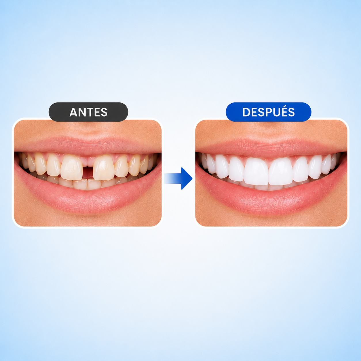 SNAP SMILE™ CARILLAS DENTALES REMOVIBLES
