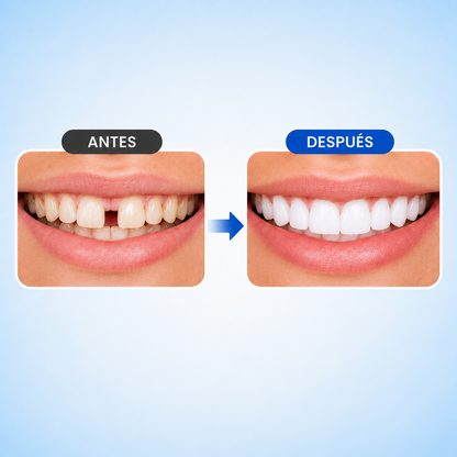SNAP SMILE™ CARILLAS DENTALES REMOVIBLES